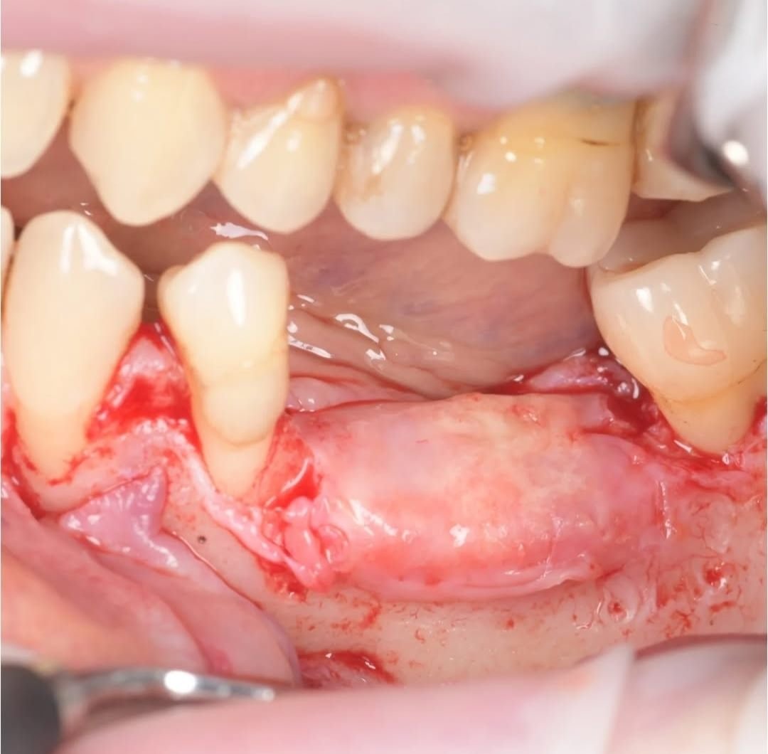 Cresta alveolar estrecha expuesta durante la cirugía de aumento de volumen óseo