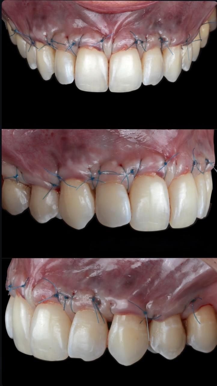 Tres vistas del postoperatorio inmediato de una cirugía plástica periodontal, con las suturas finas cubriendo las raíces expuestas