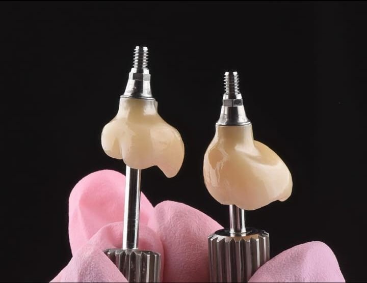 Dos coronas de porcelana montadas sobre sus pilares de implante antes de ser colocadas