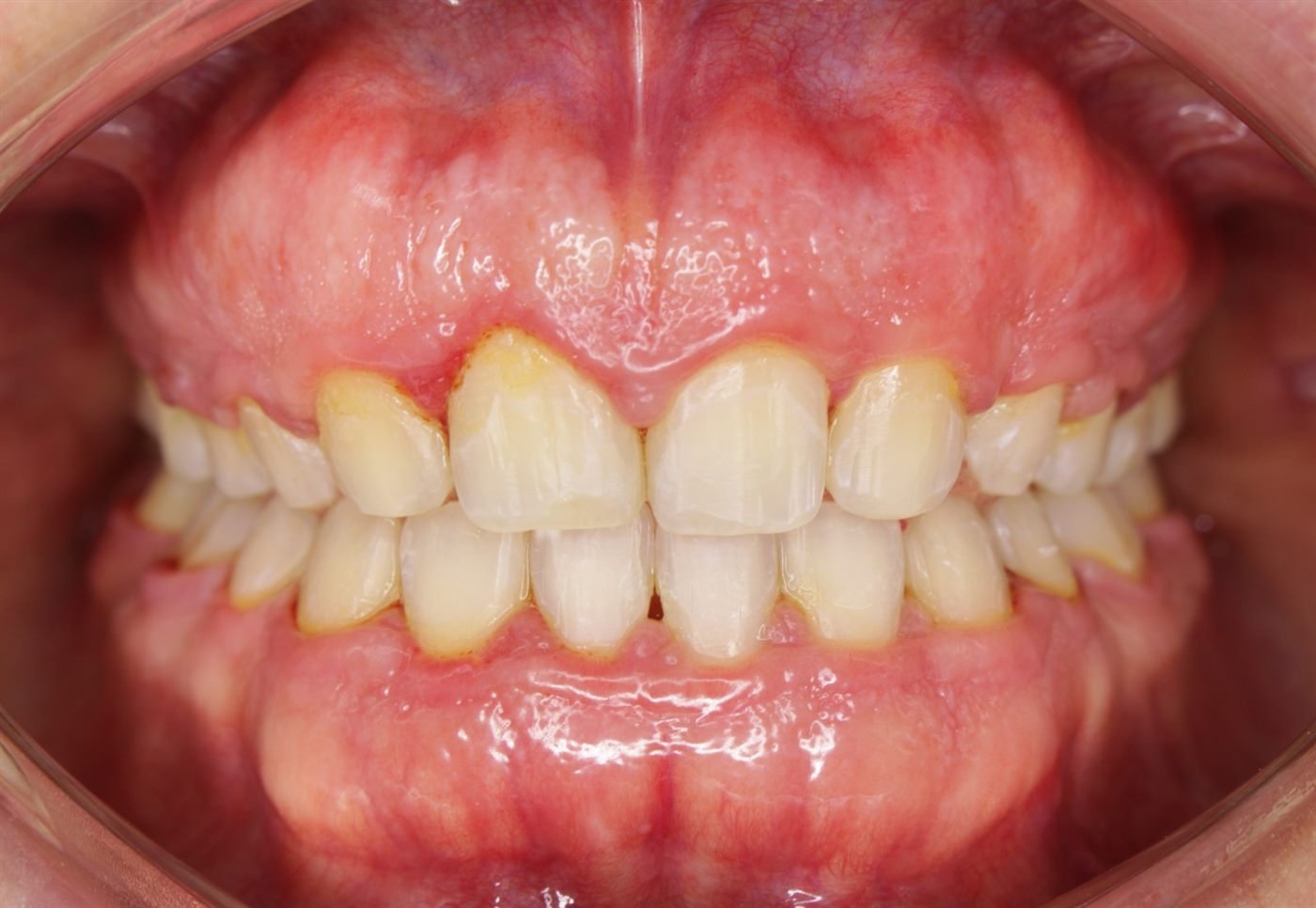 Encías con inflamación importante, enrojecidas y aumentadas de volumen, antes del tratamiento periodontal