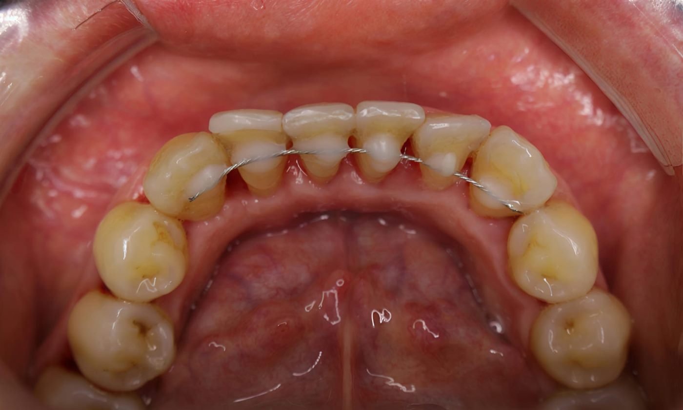 Vista oclusal de una ferulización de dientes anteriores inferiores con movilidad por enfermedad periodontal