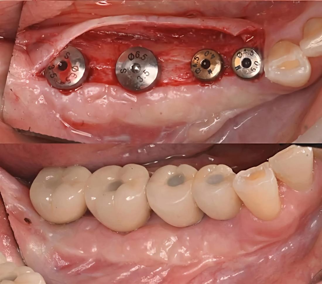 Arriba, cuatro implantes colocados con sus tapas de cierre; abajo, la prótesis fija terminada sobre esos mismos implantes