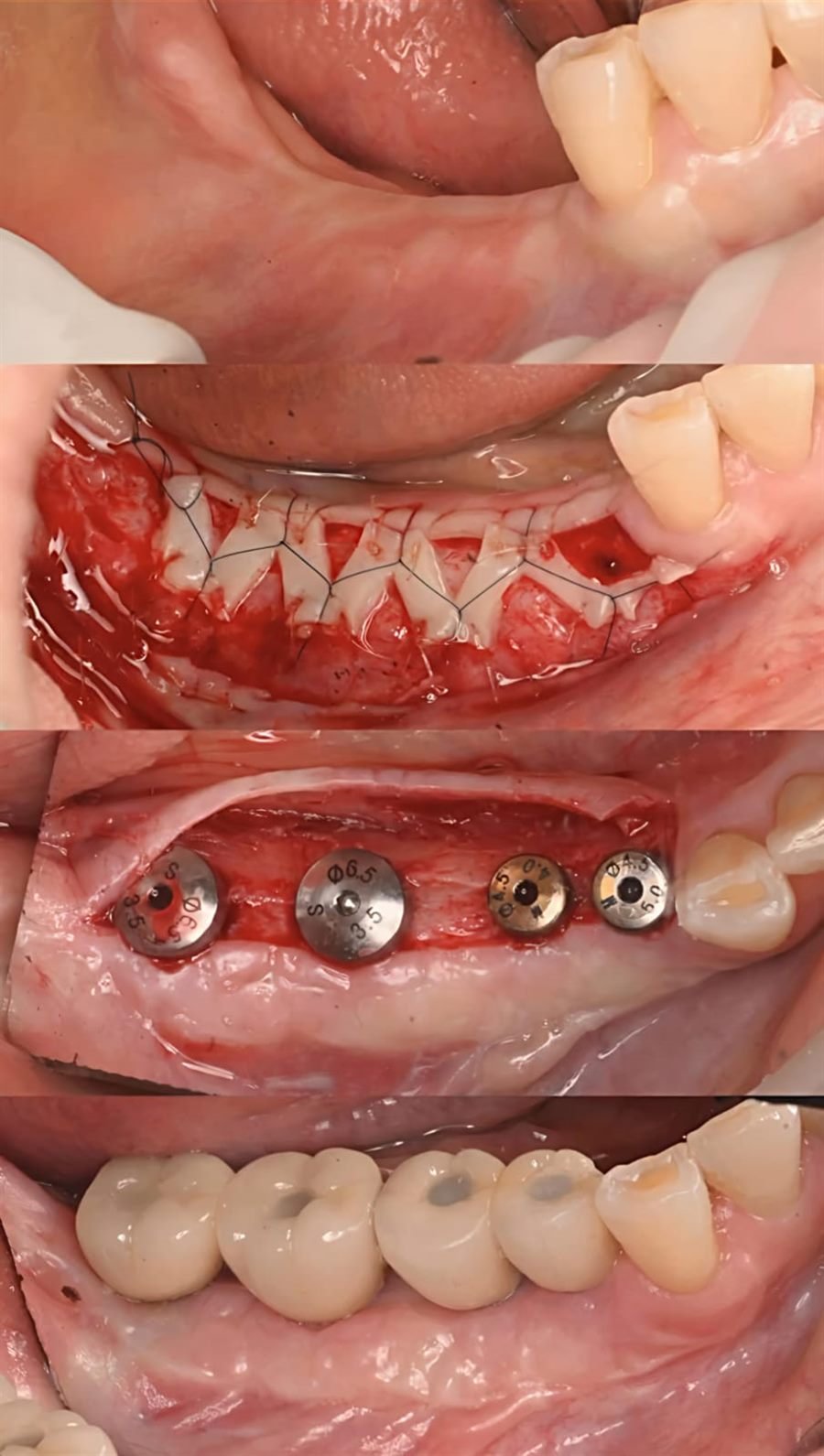 Secuencia de cuatro etapas de una rehabilitación con implantes dentales: zona sin dientes, sutura tras la cirugía, implantes colocados y prótesis final atornillada