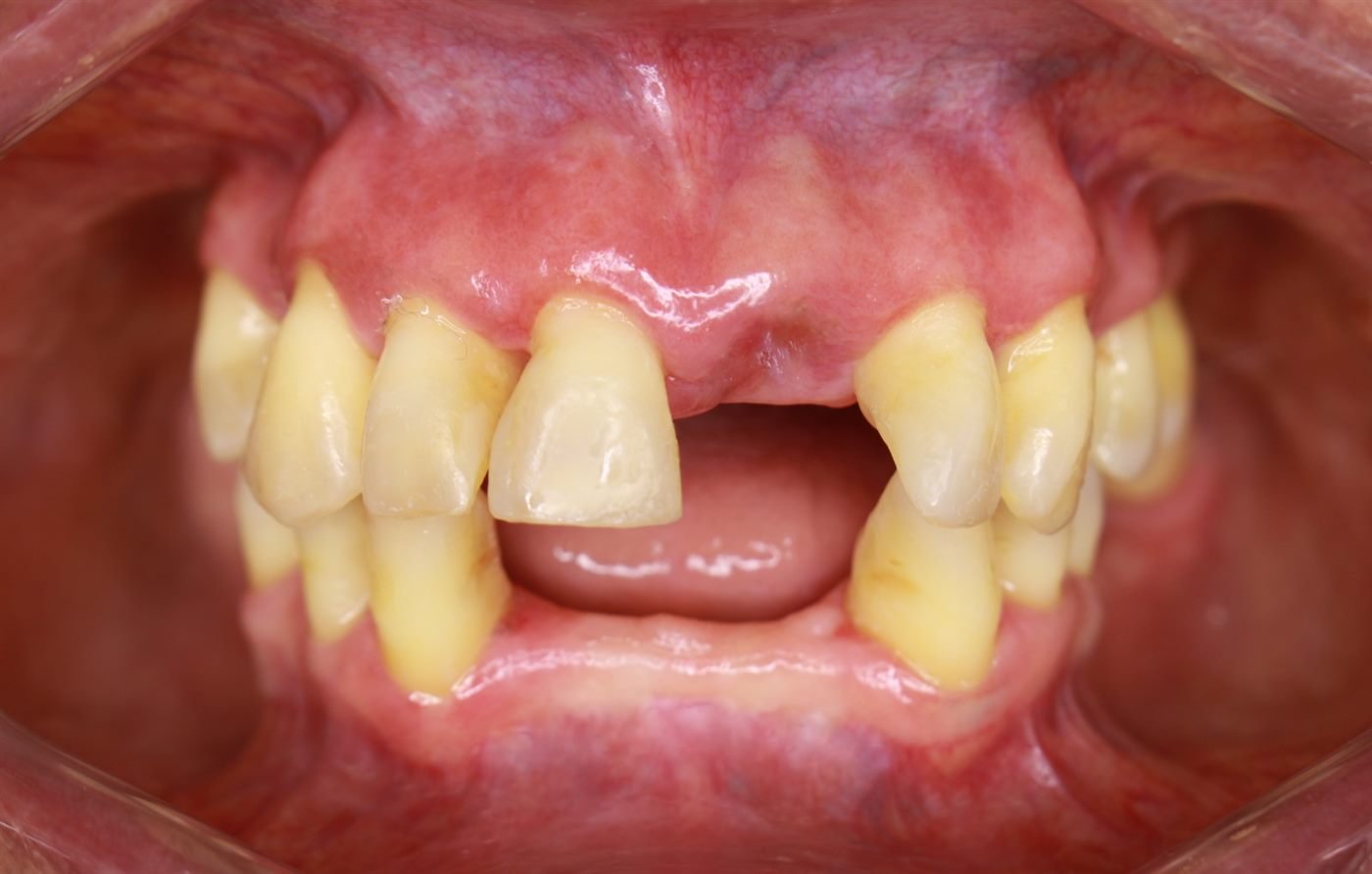 La misma boca tras el tratamiento periodontal: encías desinflamadas y sanas, lista para la fase protésica