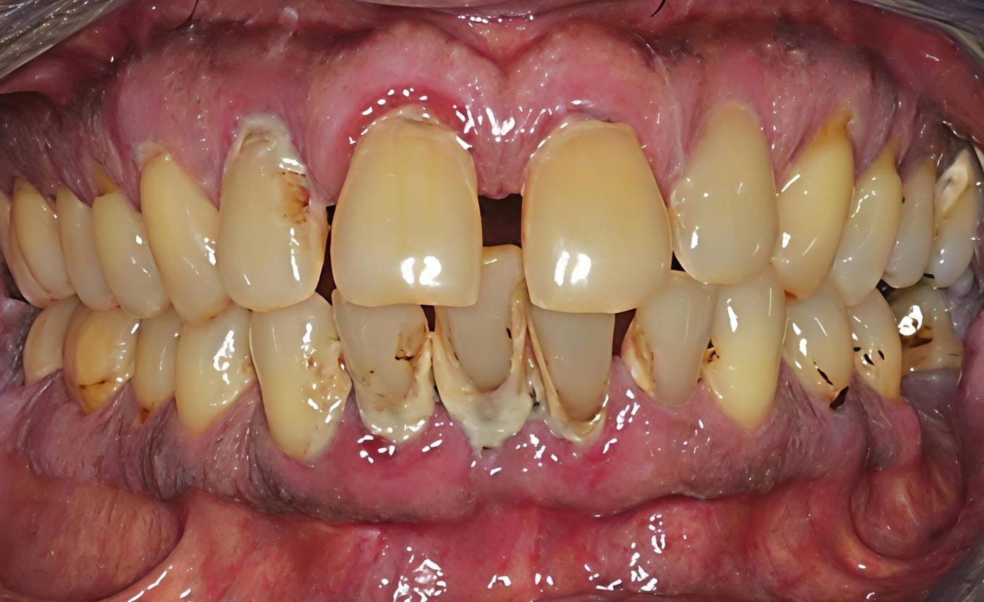 Dentadura con sarro abundante, recesión de encías y pérdida de soporte óseo por periodontitis avanzada