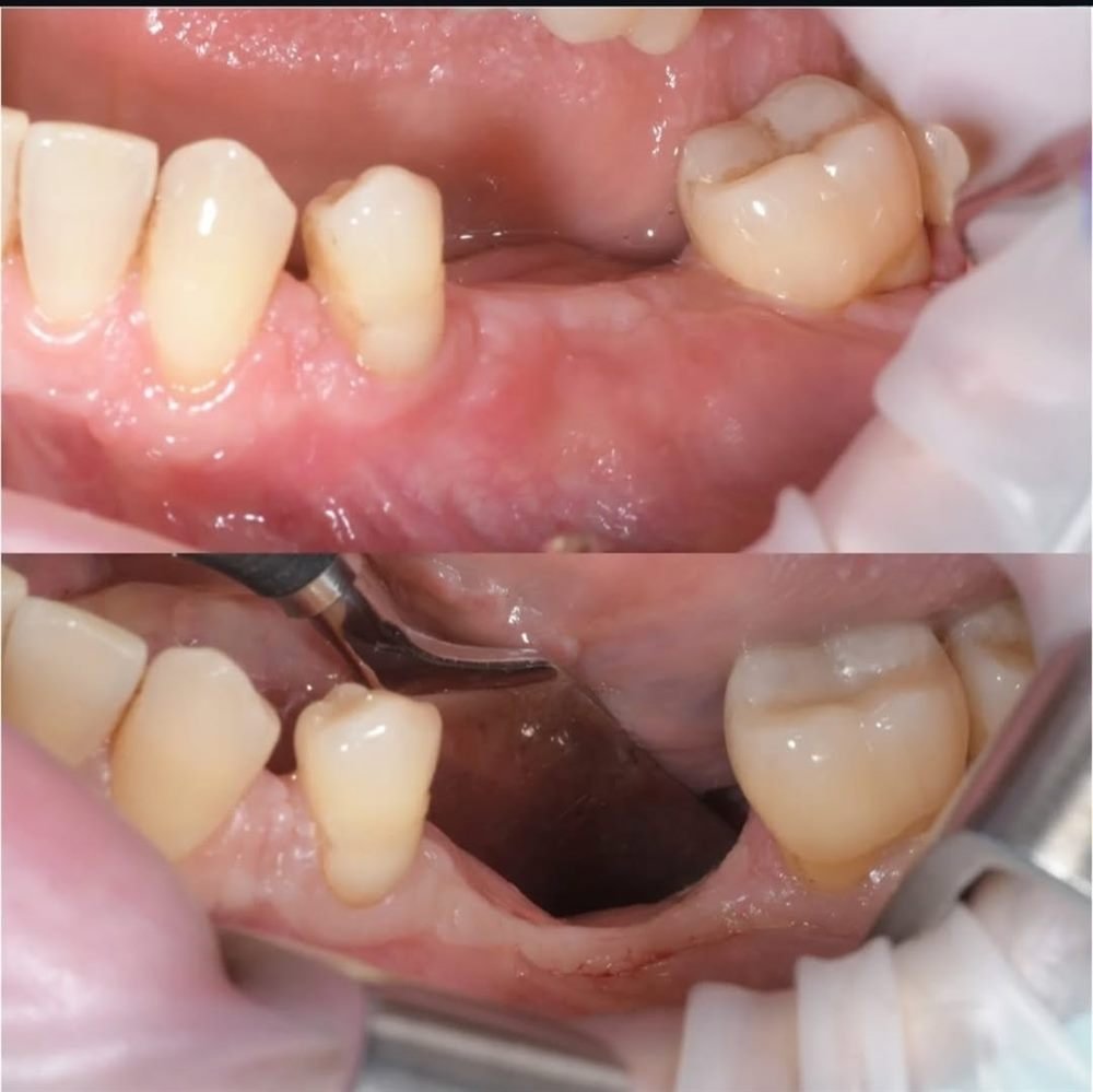 Zona sin diente antes y después de la preservación alveolar, conservando el volumen del reborde