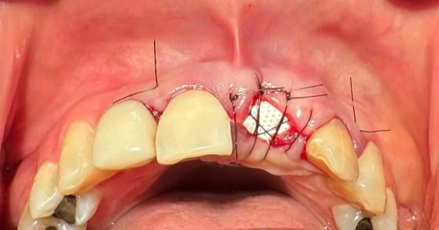 Preservación alveolar tras una extracción: el biomaterial blanco protege el alveolo para conservar el volumen de hueso