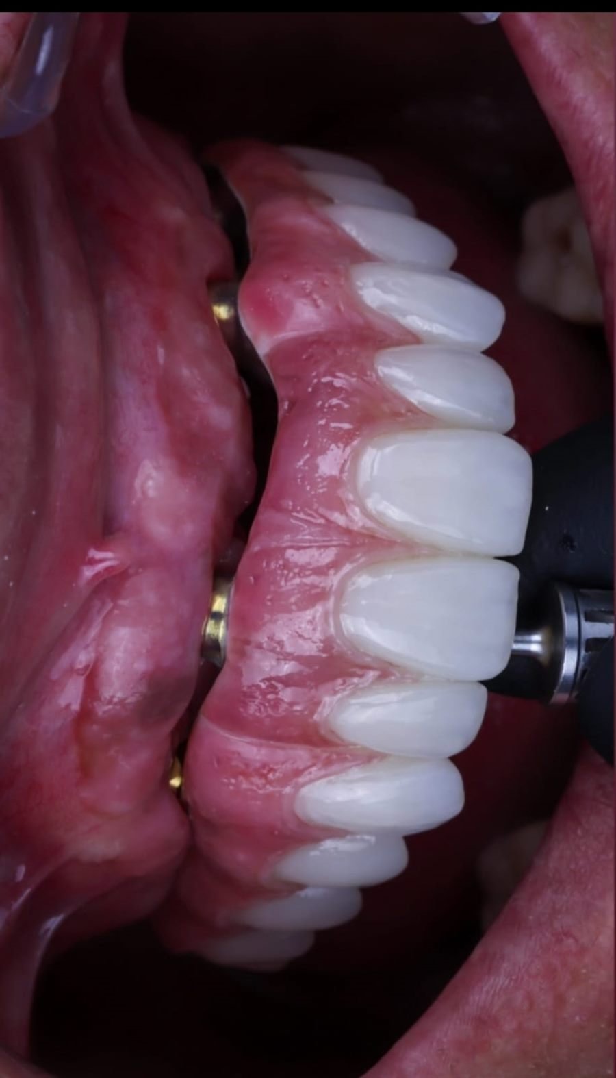 Prótesis fija atornillada sobre implantes dentales en la arcada inferior, con encía sana alrededor