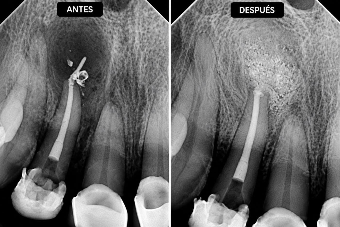 Radiografías antes y después de una regeneración ósea: a la izquierda el defecto de hueso alrededor de la raíz; a la derecha el material de injerto ocupando esa zona