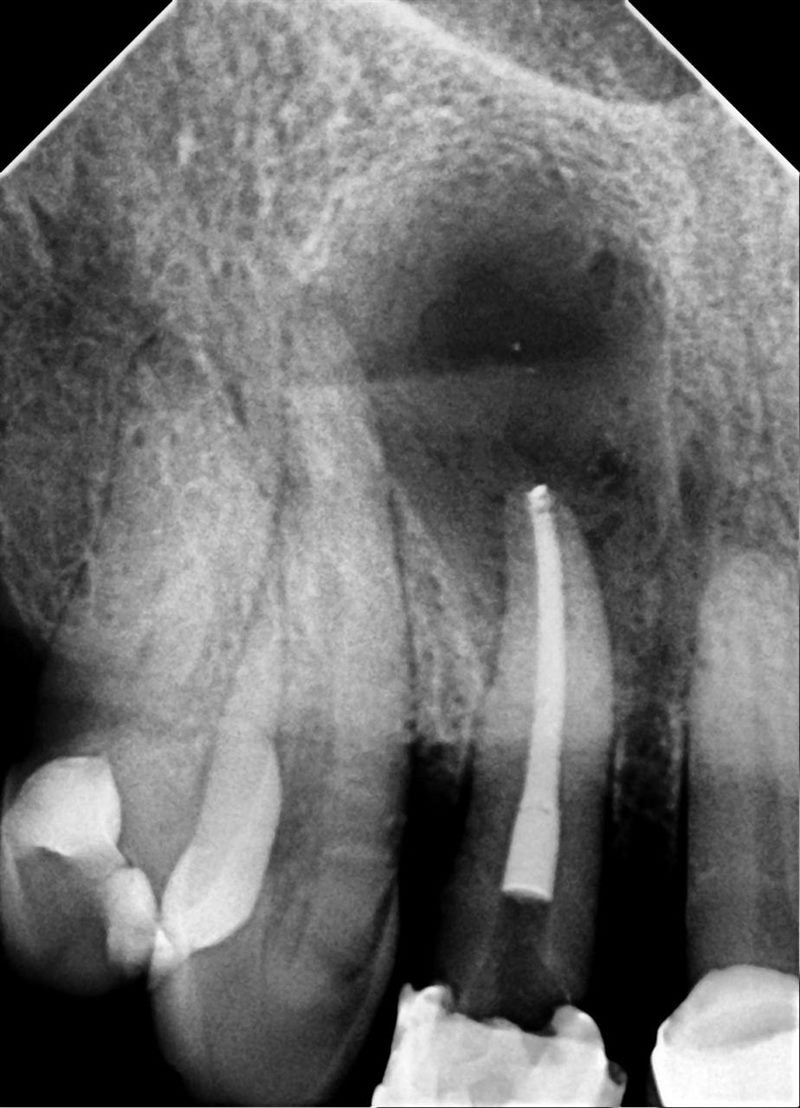 Radiografía periapical previa que muestra pérdida de hueso alrededor de la raíz de un diente anterior superior