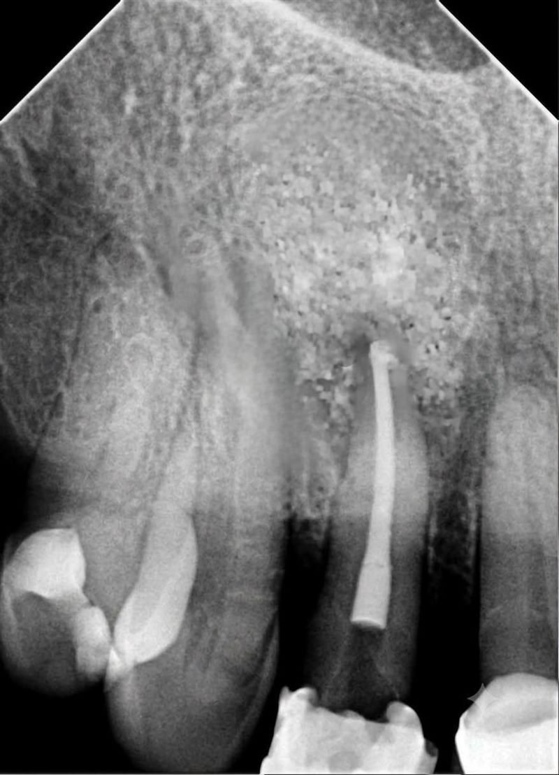 Radiografía periapical de control tras la regeneración ósea, con el material de injerto ocupando el defecto