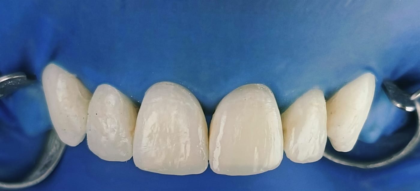 Detalle del acabado y pulido de una restauración de dientes anteriores superiores bajo aislamiento con dique de goma