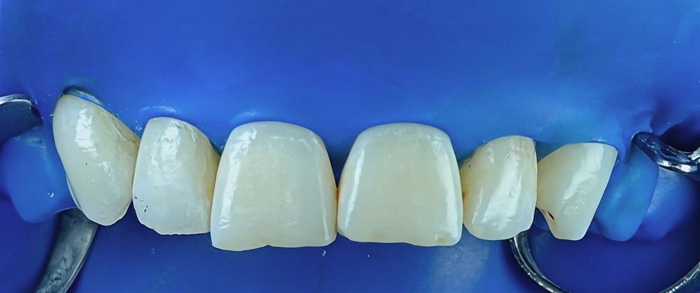 Restauración de dientes anteriores superiores trabajada bajo aislamiento absoluto con dique de goma