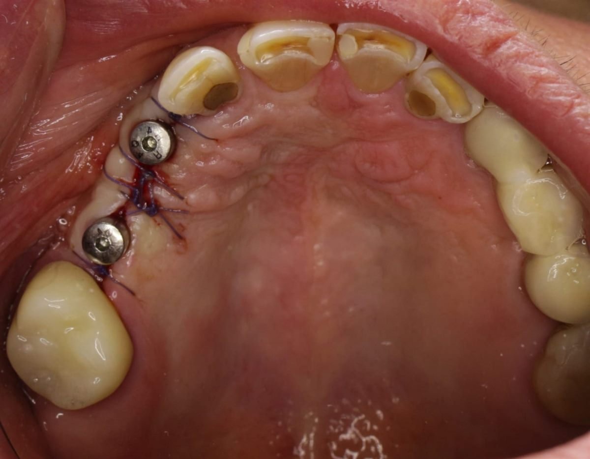 Vista oclusal de tornillos cicatrizales colocados sobre implantes para formar el perfil de emergencia de la encía