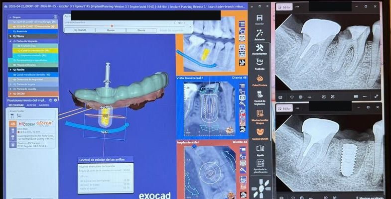 Diseño de una guía quirúrgica para cirugía guiada de implantes en software especializado