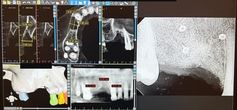 Planeación digital de un implante en software 3D a partir de una tomografía computarizada