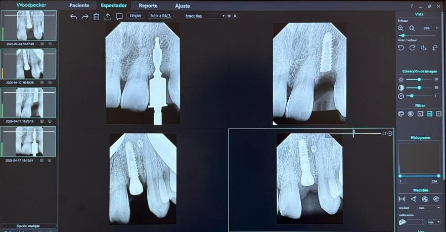 Radiografías digitales de control de un implante dental mostradas en el software del consultorio